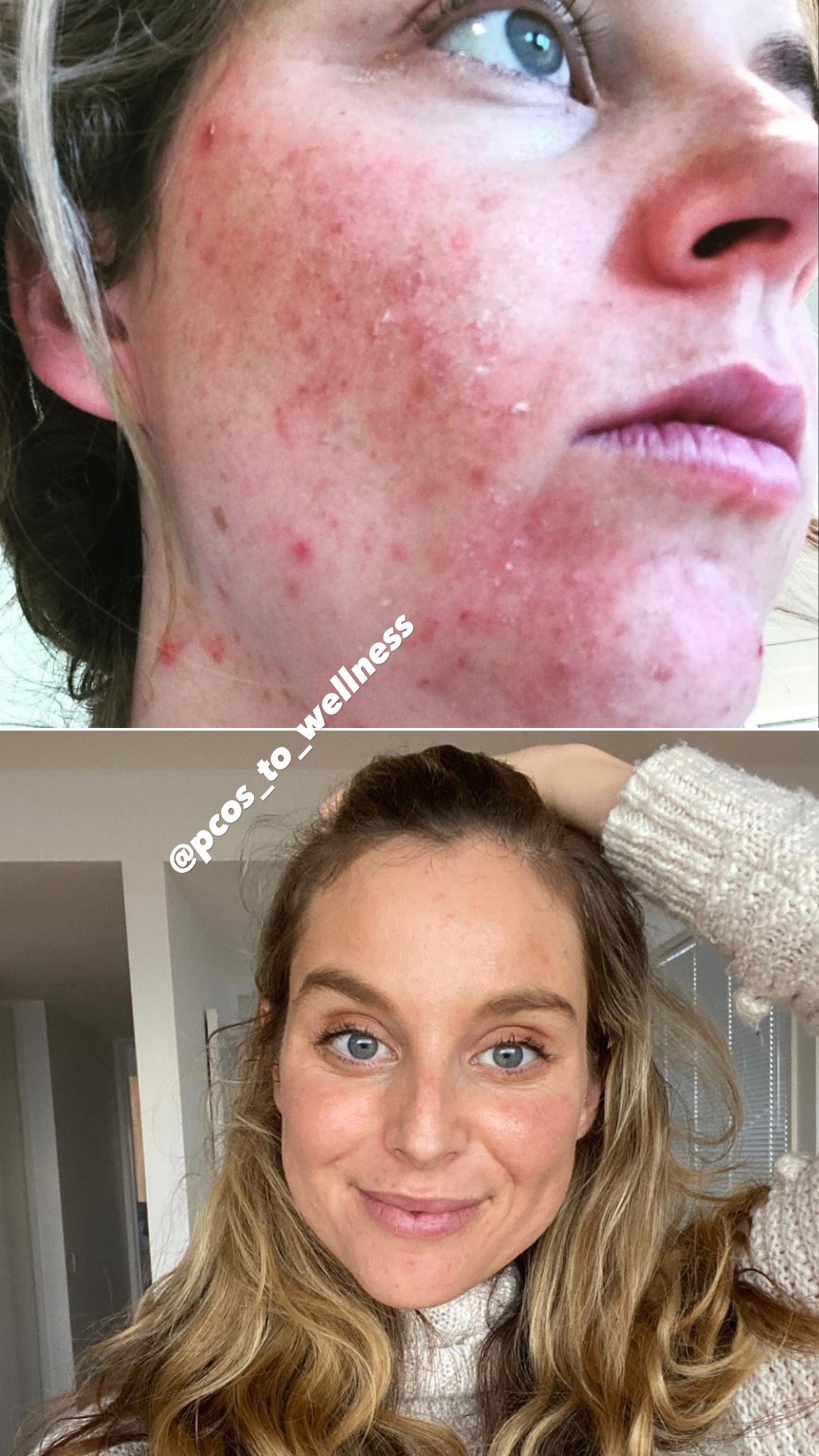 glutathione pcos acne My skin journey, the real, raw and unfiltered. Living with PCOS means I'll always be managing in some way. Some days are smooth, some days flare up but I've learned Glutathione Whitening Pills - 120