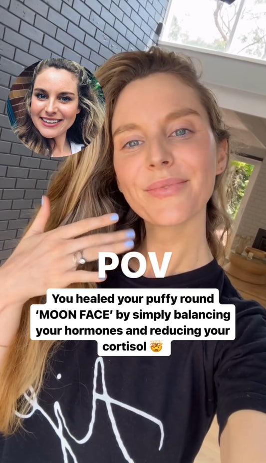 What is “Moon Face” and Why Is It Linked to PCOS?