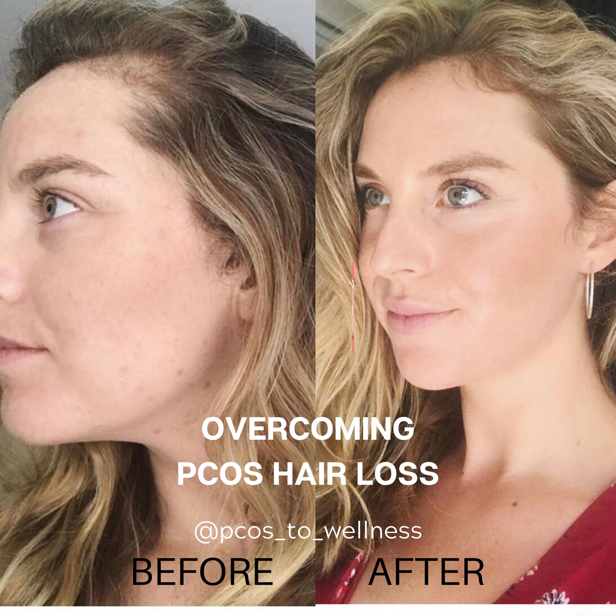 6 tips to help treat PCOS hair loss PCOS To Wellness