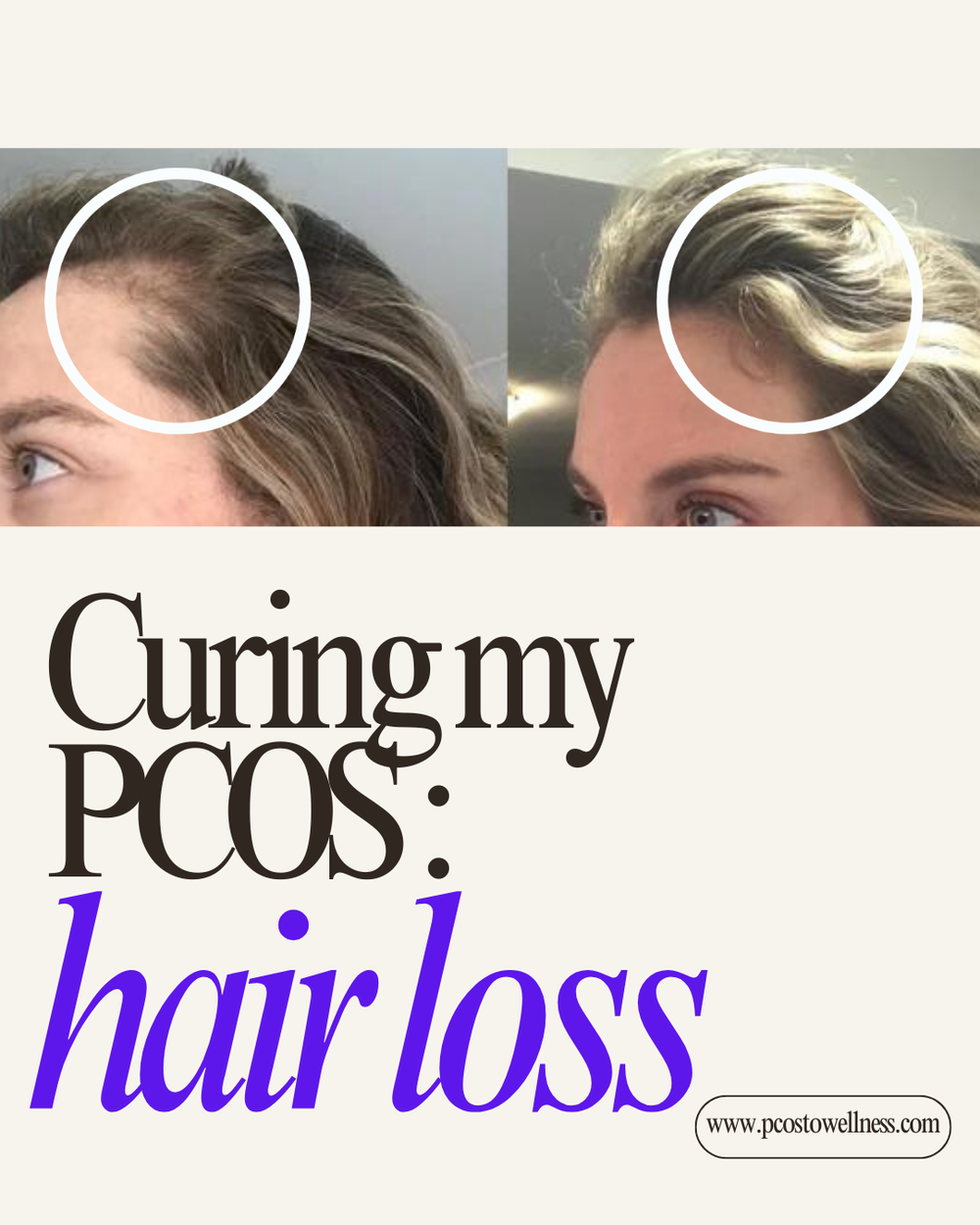 Curing My PCOS Hair Loss - PCOS To Wellness