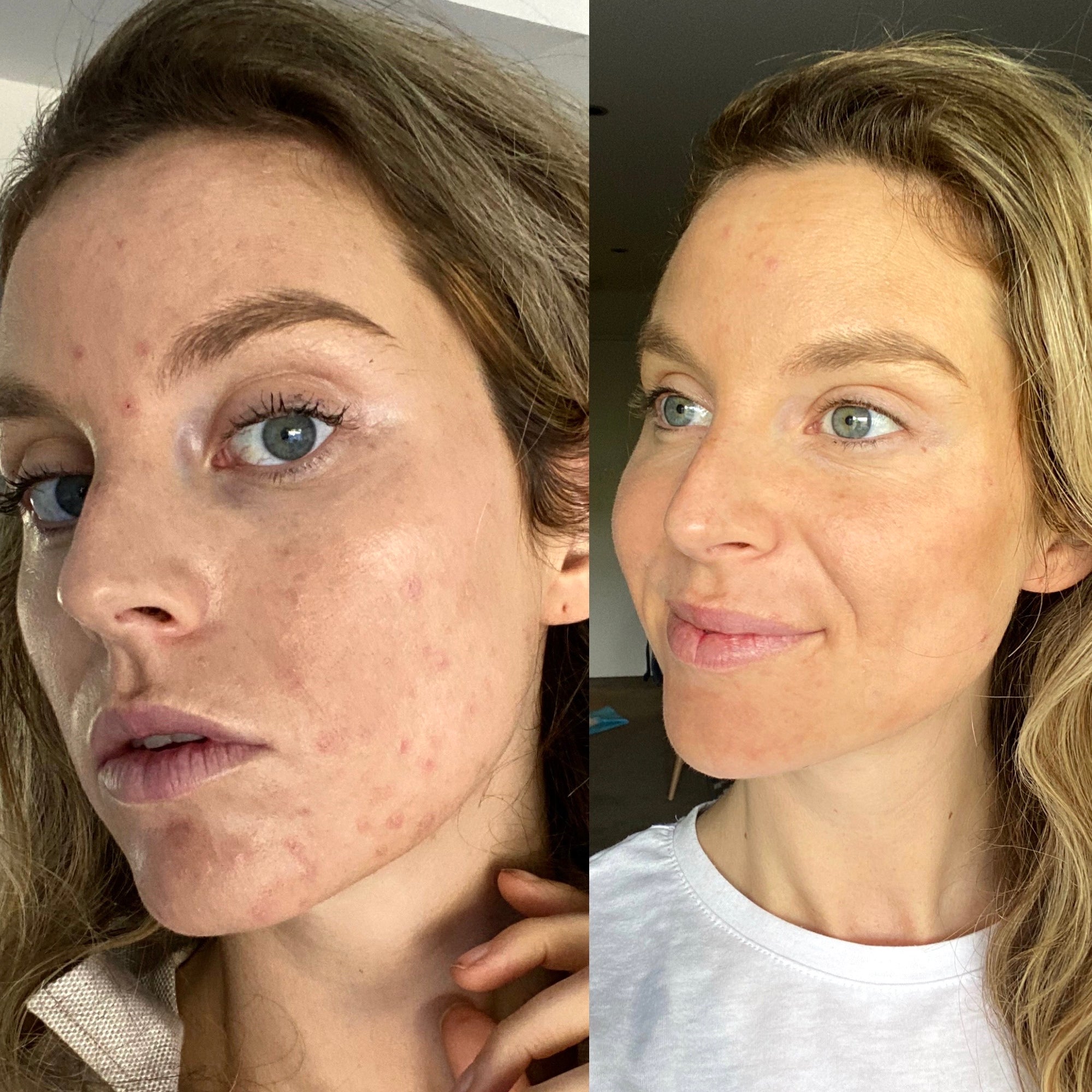 How I Healed My PCOS Acne Naturally
